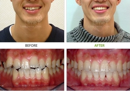 치아교정 얼굴형]발치여부에 따른 얼굴형 변화의 차이(사진첨부) : 네이버 블로그