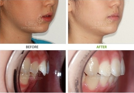 치아교정 얼굴형]발치여부에 따른 얼굴형 변화의 차이(사진첨부) : 네이버 블로그