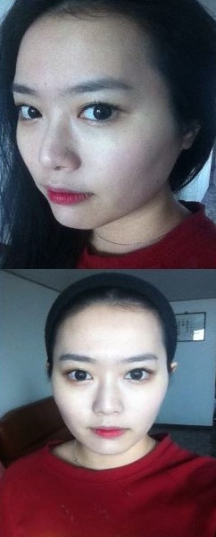 整形体験談 症例 輪郭整形 エラ削り 頬骨削り と鼻整形をやりました 네이버 블로그