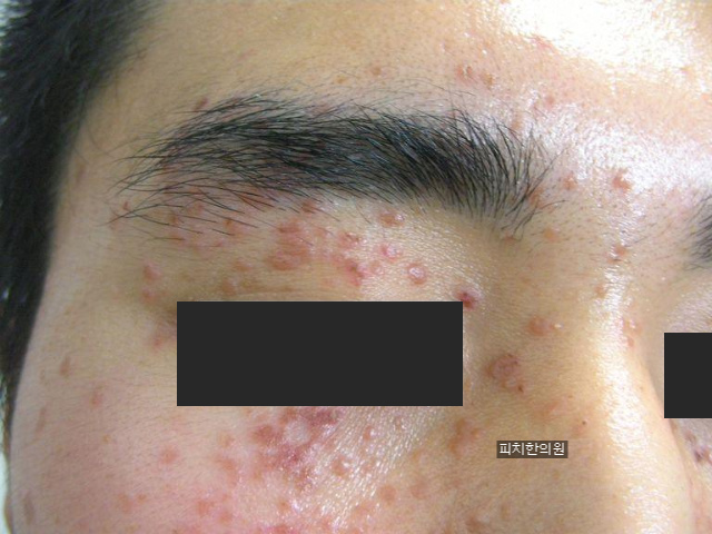 수원 편평 사마귀 제거 치료 라인 핑크 범프