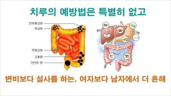 슬러지 치질, 치루가 생기는 원인을 알고 싶습니다. 5