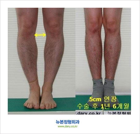 오다리수술 후 정말 키가 커질 수 8