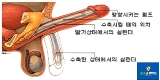  (강동구 발기부전/천호 발기부전) 발기부전 음경보형물 수술 - 강동구음경보형물/천호음경보형물/강남음경보형물/구리음경보형물/남양주음경보형물/중랑구음경보형물/하남음경보형물/성남음경보형물/광진구음경보형물/송파구음경보형물/경기도음경보형물/강원도음경보형물