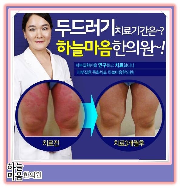 울산두드러기병원 말끔한피부
