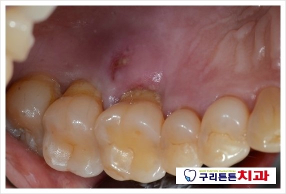잇몸이부어서 아파요 ㅠㅠ
