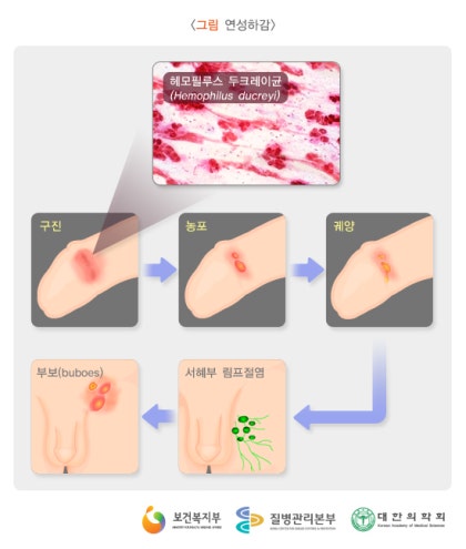 헤모필루스 듀크레이 궤양