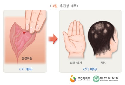 헤모필루스 듀크레이 궤양