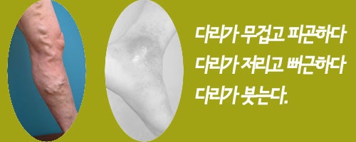 의정부하지정맥류 다리통증 유발하는 정맥류.