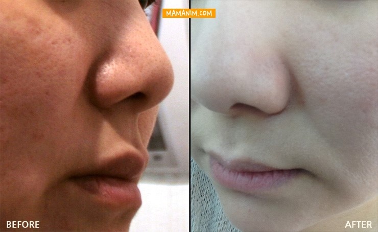  [수원피부관리] 필스킨케어에서 아쿠아필로 여름나기..