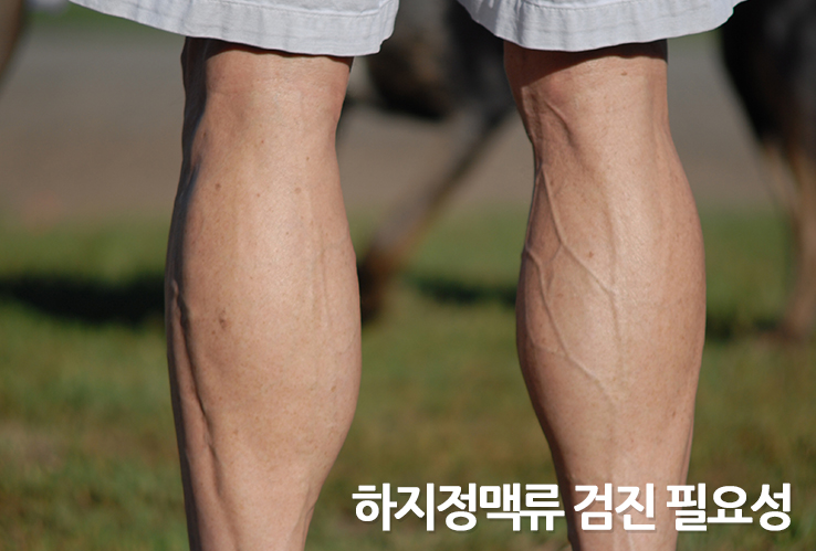 경기 광주 하지정맥류, 내 다리에 1