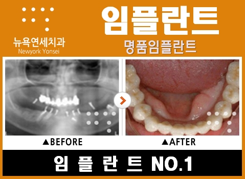  임플란트비용문의,임플란트비용상담,임플란트종류,임플란트과정