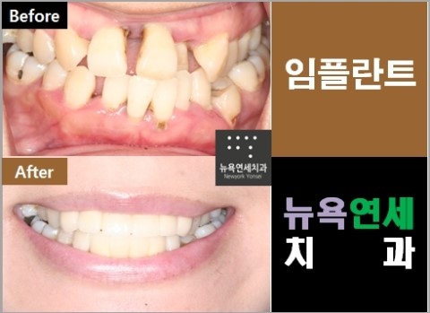  @@@@앞니임플란트,강남임플란트,역삼임플란트,치아임플란트