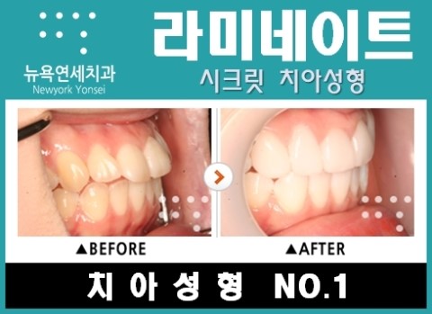  [라미네이트 앞니성형 질문과 답변] 앞니 라미네이트 궁금 한 점이 있어요.