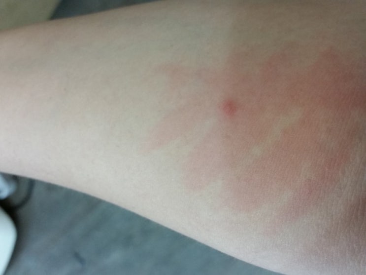 광주 피부묘기증 가볍게 넘기기 쉬운 피부질환 12