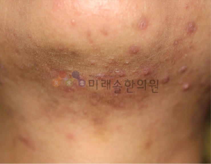 신길한의원 여드름이 목에 있으면 신길한의원 여드름이 목에 있으면