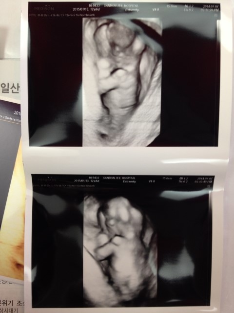 임신 12주6일차 _ 1차 정밀초음파, 목투명대검사