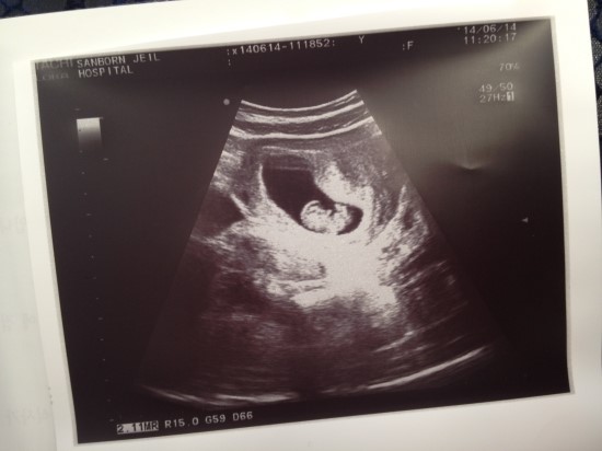 임신 9주4일차 _ 팔, 다리 뿅뿅