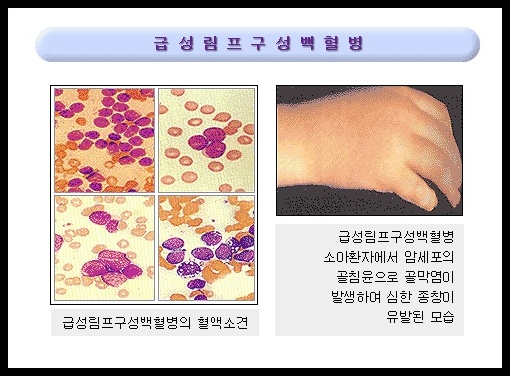 백혈병 초기증상 및 원인 3