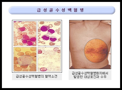 백혈병 초기증상 및 원인 7