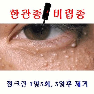 이효리 얼굴의 한관종 쉽게 제거할수 있나? 있다. - 점크린