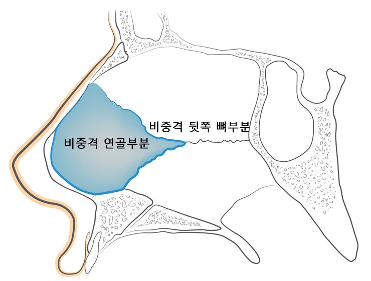 비중격만곡증 재발과 재수술