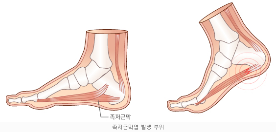  [족저근막염신발]기능성신발 운동화 24HRS는 족저근막염 무지외반 등 발질환 및 통증 치료신발 