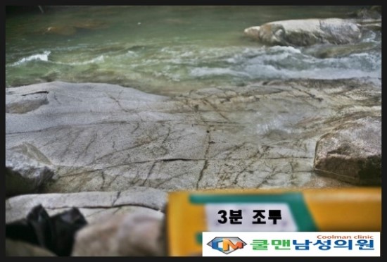  (구리 비뇨기과/ 하남 비뇨기과) 조루수술로 남자의 자존심을 세우자!!! - 강동구조루수술/천호조루수술/길동조루수술/구의동조루수술/장안동조루수술/구리조루수술/남양주조루수술/중랑구조루수술/하남조루수술/성남조루수술/광진구조루수술/송파구조루수술/가평조루수술/포천조루수술/강원도조루수술/경기도조루수술