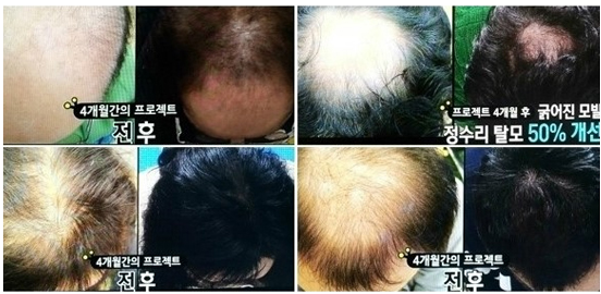  어성초를 활용한 발모액만드는법 - 엄지의제왕 탈모효과