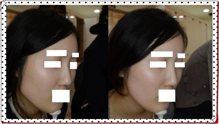 대구턱보톡스 날렵한 턱선을