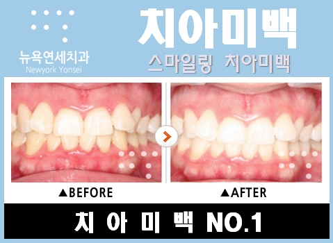 줌을 이용한 치아미백 프로그램별  치아미백전후 사례 입니다.