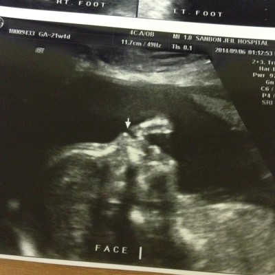 임신 21주4일차 _ 2차정밀초음파, 갑상선 피검