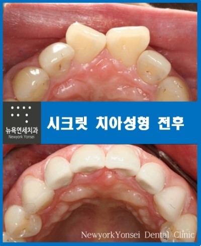  앞니돌출교정비용,앞니돌출교정,앞니돌출라미네이트,앞니돌출올세라믹