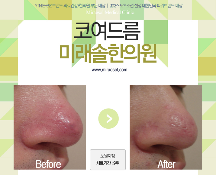 코여드름의 원인을 알고 케어