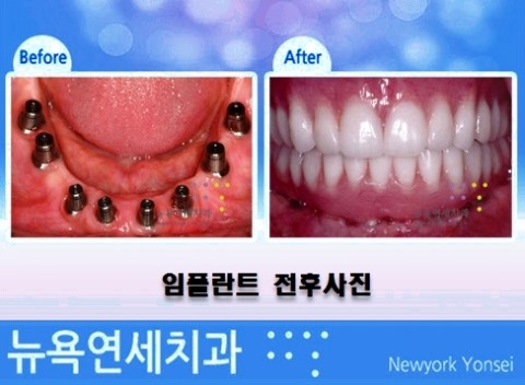  어금니임플란트치료,어금니임플란트,어금니임플란트비용,어금니임플란트방법