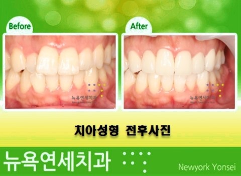  치아교정라미네이트비용,치아교정라미네이트,치아교정라미네이트시술,치아교정라미네이트방법