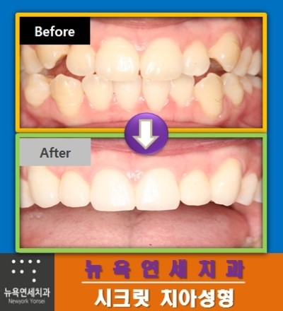  앞니치아교정방법,앞니치아교정,앞니치아성형비용,앞니치아성형잘하는곳