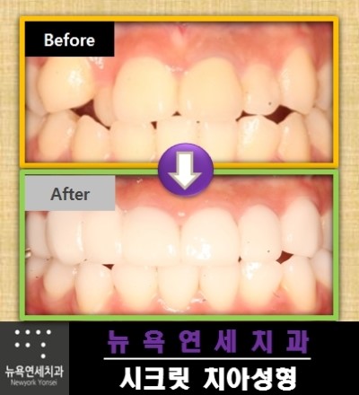  [앞니치아성형 종류] 덧니치아성형,벌어진치아성형,불규칙앞니치아성형