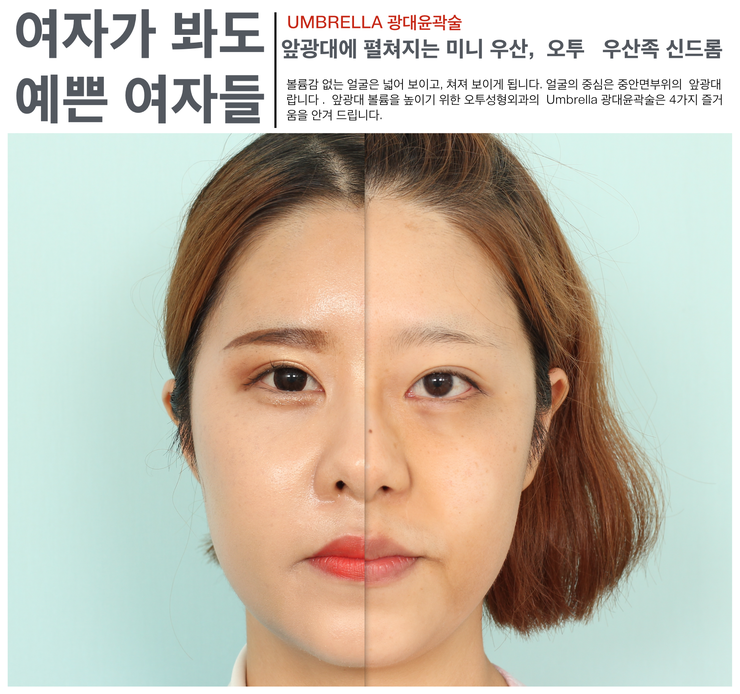 부산광대수술 잘하는곳 이곳인가요 8