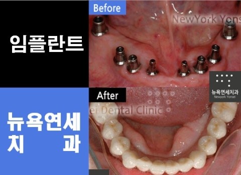  임플란트치아비용,임플란트치아,임플란트치아싼곳,임플란트치아잘하는곳