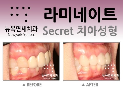  @@@ 앞니돌출교정방법,앞니돌출교정,앞니돌출라미네이트가격,앞니돌출치아교정 @@@