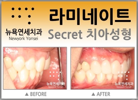  앞니치아성형치과,앞니치아성형,앞니치아성형추천,앞니치아성형전문치과