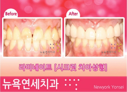  앞니교정사진,앞니교정,앞니교정방법,앞니교정라미네이트