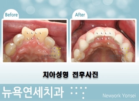  돌출앞니교정방법,돌출앞니교정,돌출앞니교정비용,돌출앞니교정치과