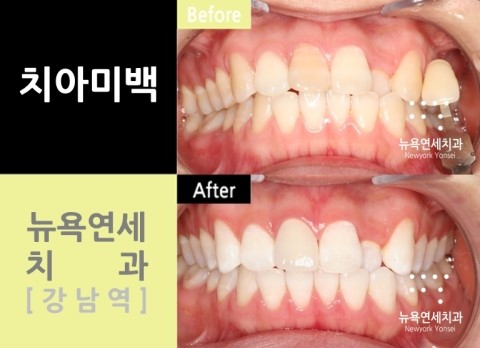  치아미백가격,치아미백가격이벤트,치아미백가격싼곳,치아미백가격비교