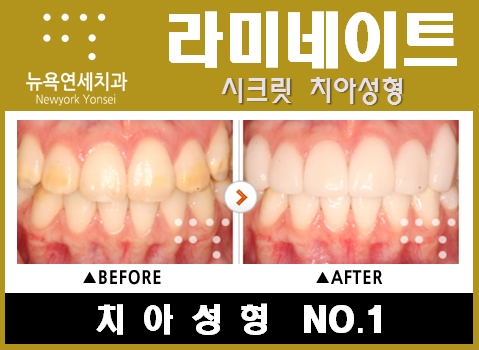  앞니치아성형,앞니치아성형치과,앞니성형비용,앞니라미네이트치아성형
