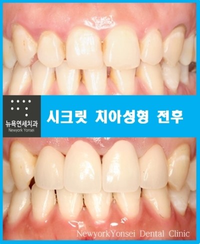  앞니성형비용,앞니성형,앞니성형비용상담,앞니성형가격