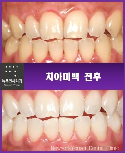  치아미백비용,치아미백,치아미백비용상담,치아미백비용이벤트