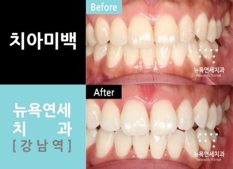  치과치아미백비용,치과치아미백,치과치아미백가격,치과치아미백방법