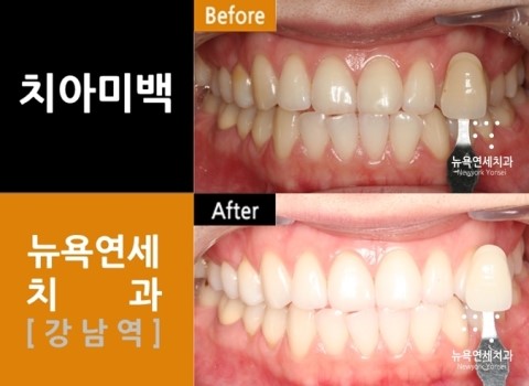  앞니치아미백비용,치아미백비용,치아미백잘하는곳,치아미백유명한치과
