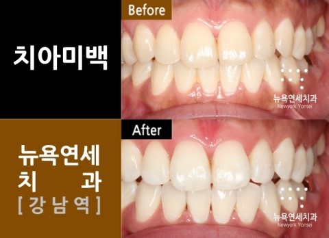 치아미백비용,치아미백,치아미백제품,치아미백방법